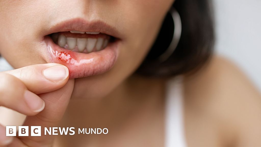 Úlceras bucales: causas, prevención y cómo aliviar sus molestias