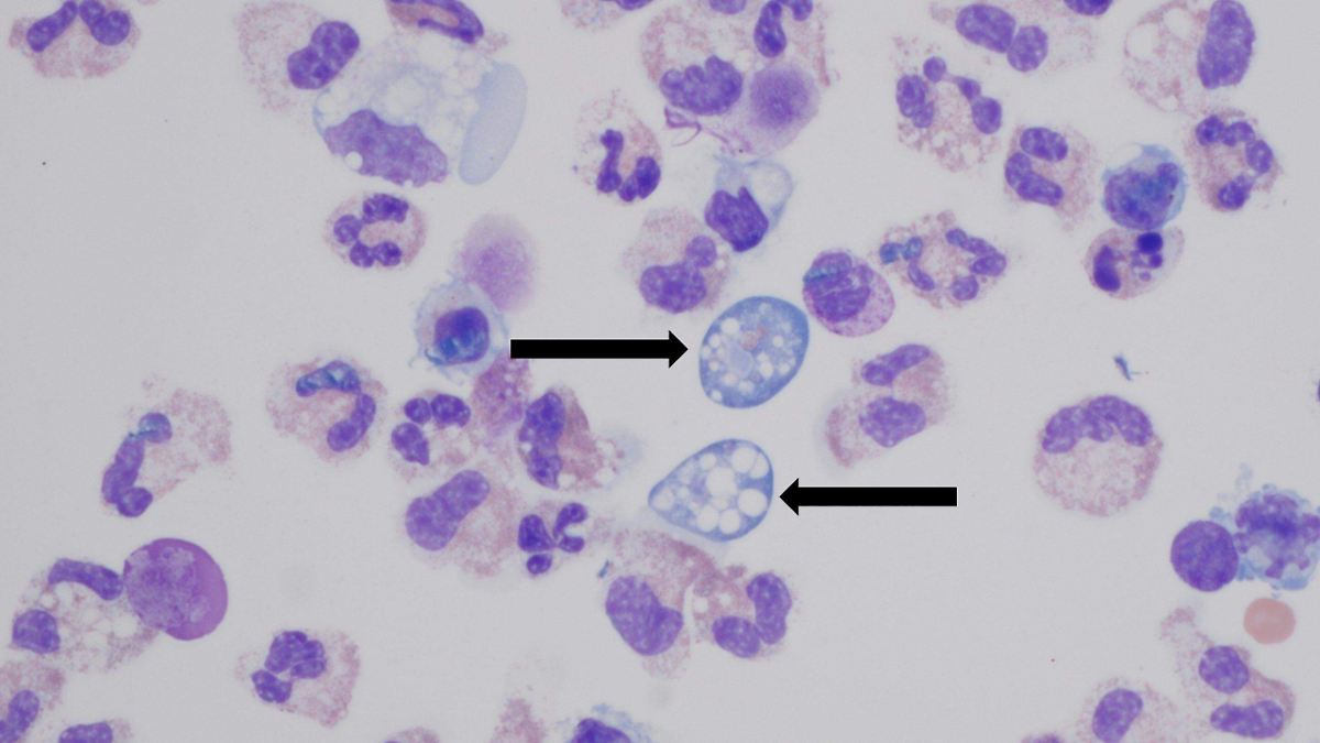 Ameba comecerebros en México: lo que debes saber sobre esta rara y letal infección